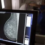 Ministério da Saúde passa a recomendar mamografia a partir dos 40 anos