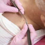 Saúde de Brusque inicia mutirão de atendimento de biópsias dermatológicas