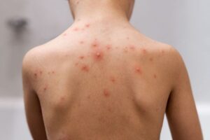 Aumento de casos de catapora preocupa autoridades de cidade catarinense