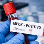 Sobe para 140 número de casos confirmados de Mpox no país, em 2026