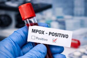 Sobe para 140 número de casos confirmados de Mpox no país, em 2026