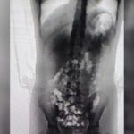 Adolescente de 13 anos é flagrada com 32 porções de skank no corpo em penitenciária de SC