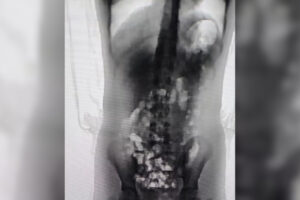 Adolescente de 13 anos é flagrada com 32 porções de skank no corpo em penitenciária de SC